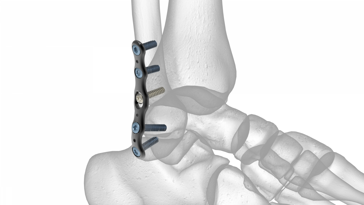 Lateral Fibula Plate Acumed